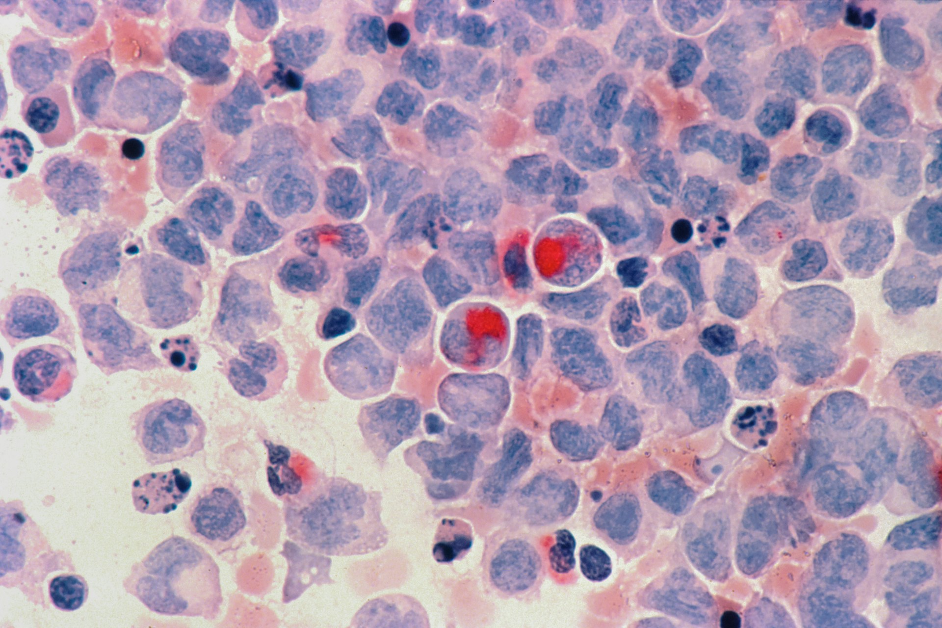 OMS evalúa el talco como “probablemente cancerígeno”